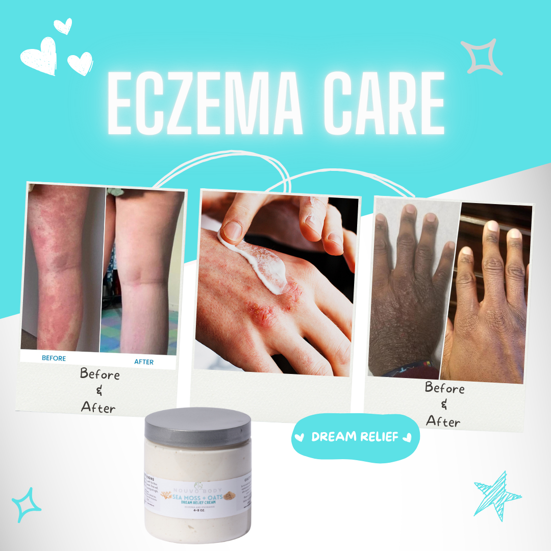 ECZEMA