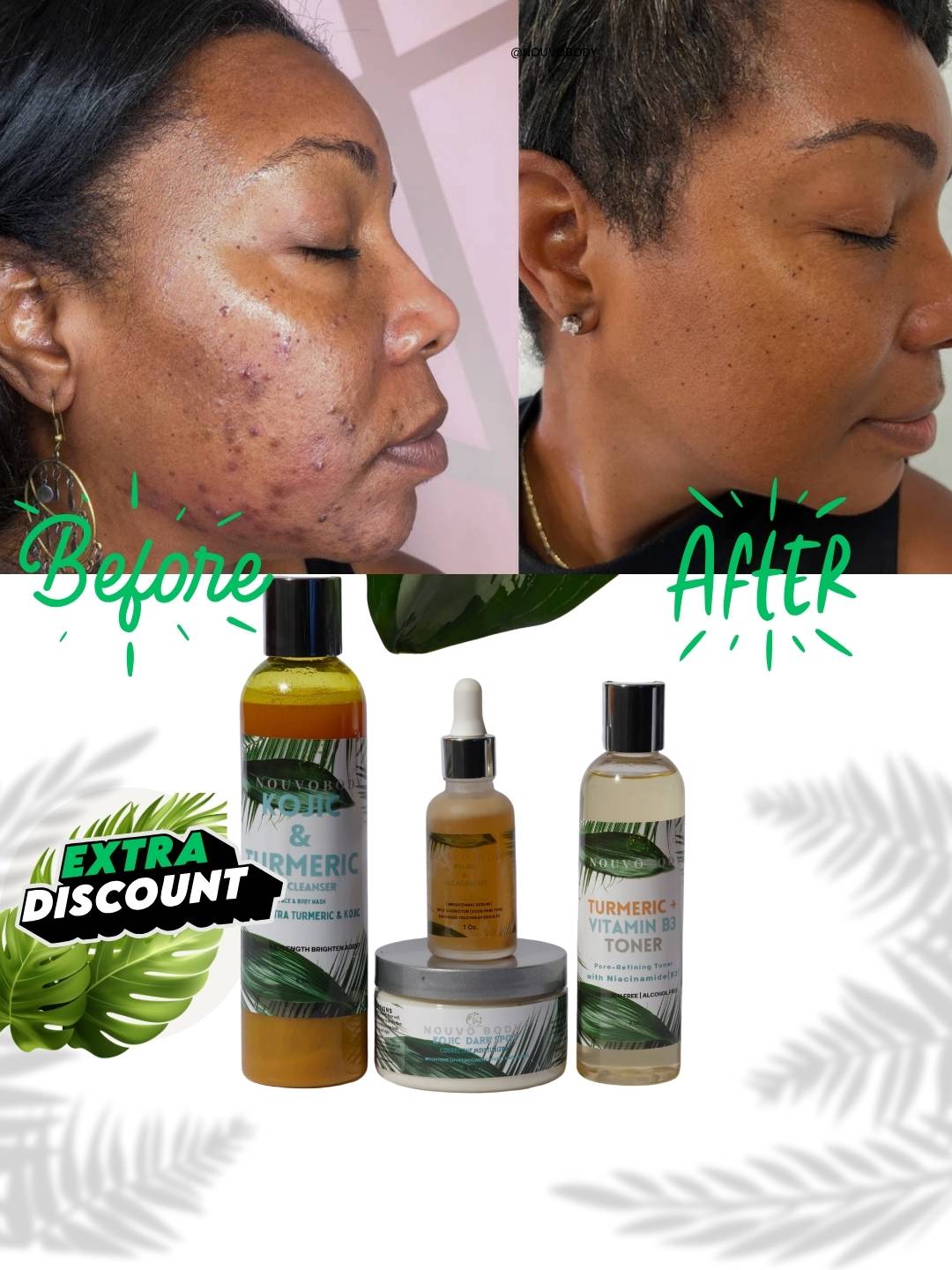 The Ultimate KoJic & Turmeric Even skin tone - Extra strength Brighten kit